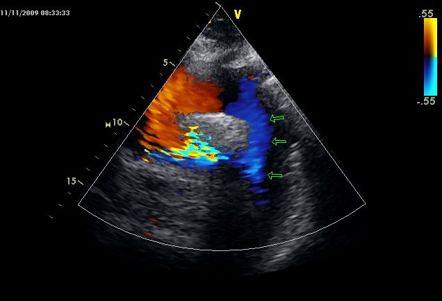 Figura S3B: aneurisma de aorta descendente