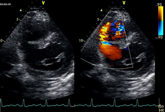 Figura S5B: insuficiência mitral grave e CIV pós-IAM