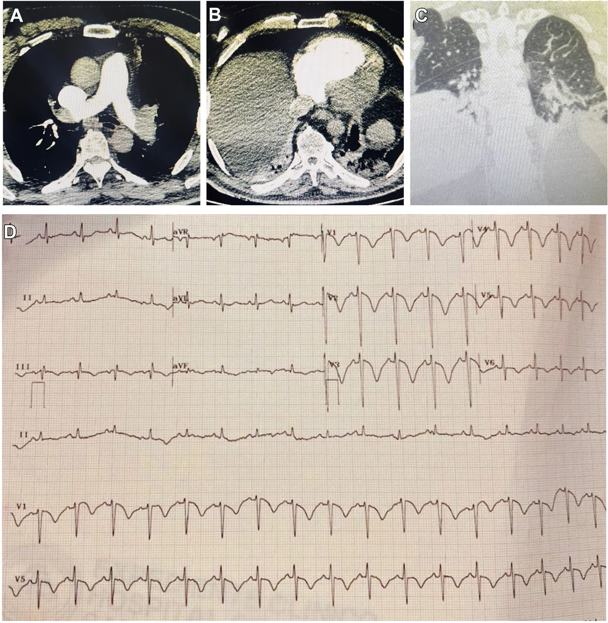 Figure 1 — Patient 1: CT pulmonary angiography, cardiac CT, coronal lung window and 12-lead ECG