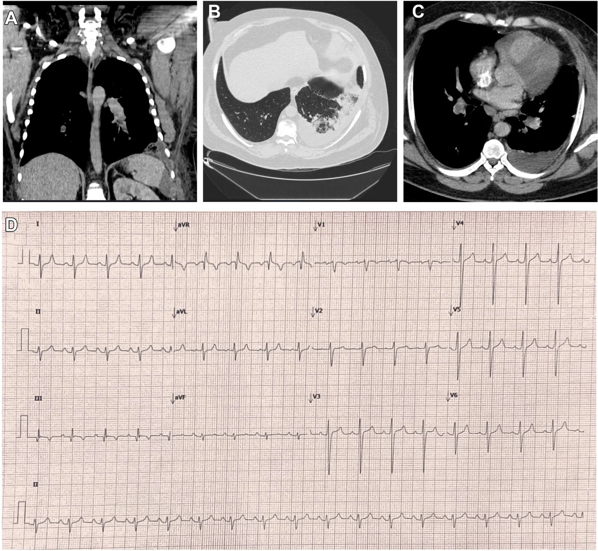 Figure 2 — Patient 2: coronal CT, lung-window axial CT, contrast axial CT and 12-lead ECG