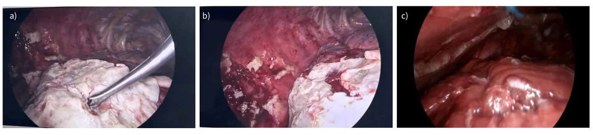 Figura 3 — Toracoscopia em cavidade pleural infectada