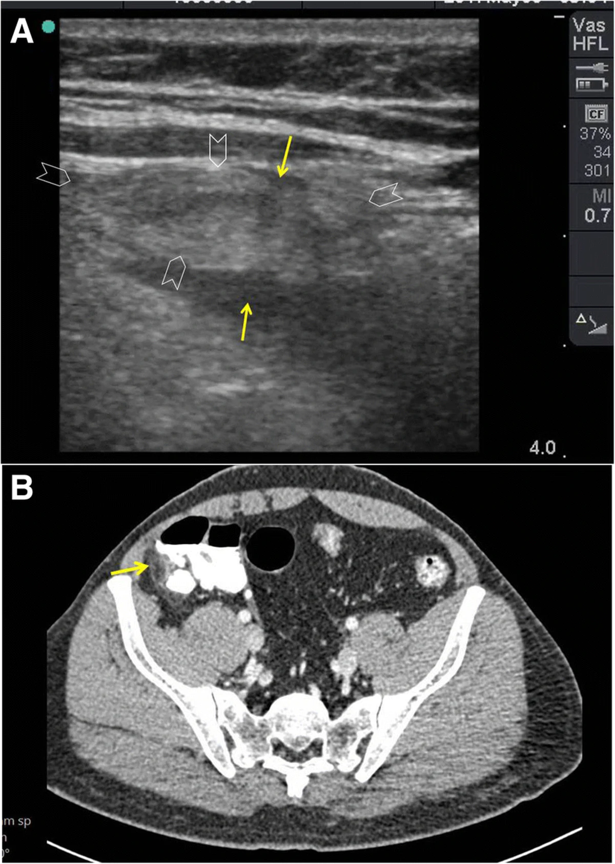 Figura 10: Homem de 36 anos, dor em FID, afebril, sem leucocitose, PCR normal. Linear: mass...
