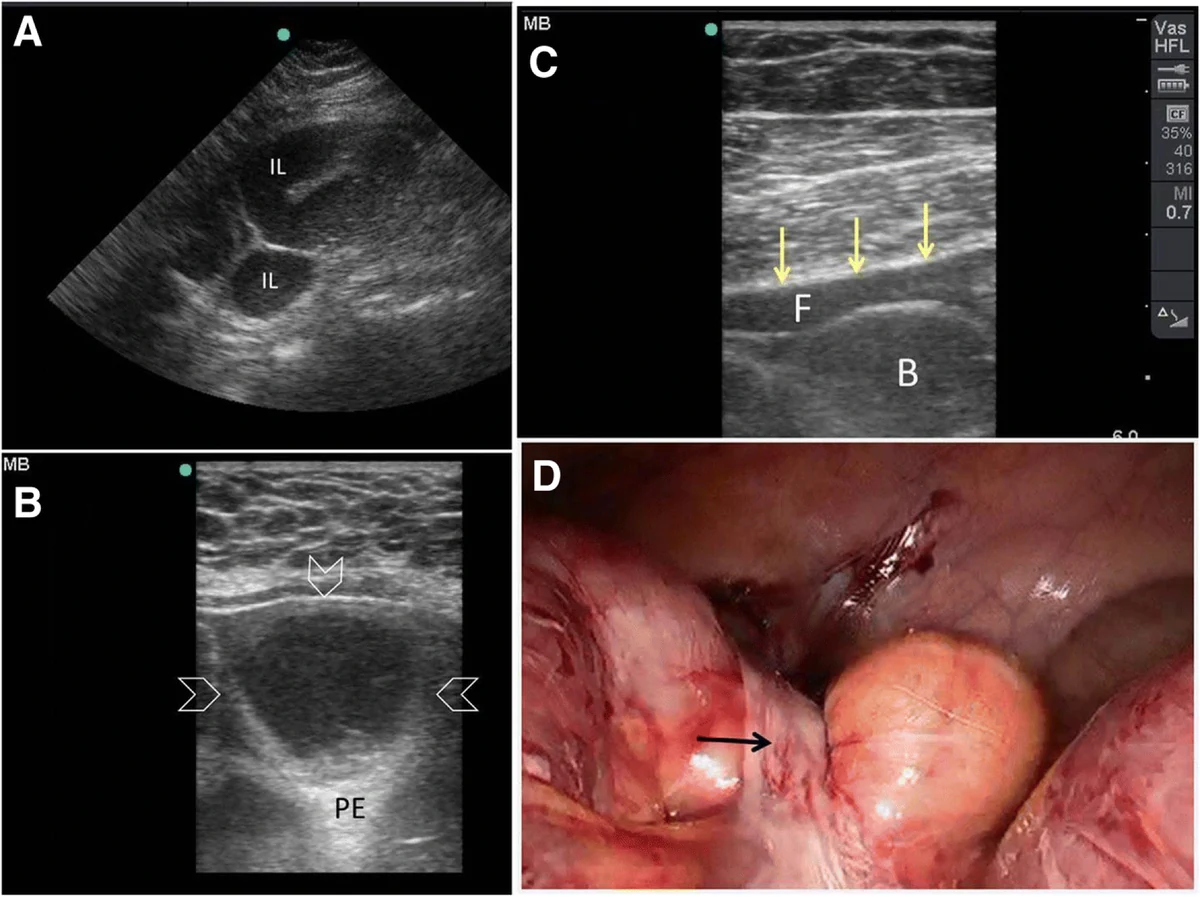 Figura 7: Mulher de 24 anos pós-cesárea: alças ileais dilatadas ativas (linear 10–12 MHz)....