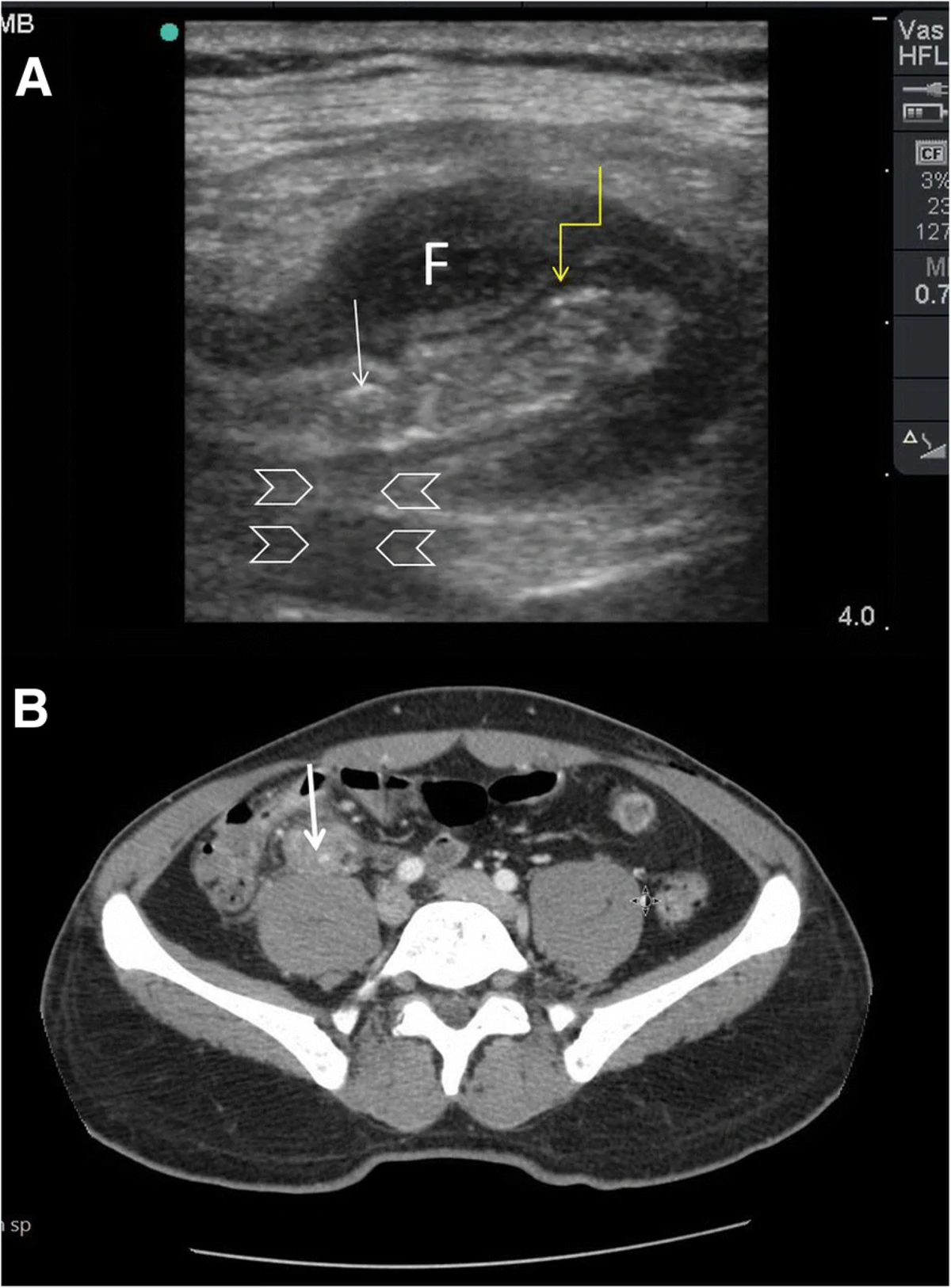 Figura 9: Homem de 40 anos, febre e dor em FID com massa dura, PCR alta. Linear de alta fr...