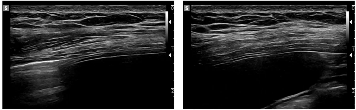 Figure 1. B-mode ultrasound images of the right hemidiaphragm acquired with a high-frequency linear probe at end-expiration and end-inspiration, used for quantitative assessment of diaphragm
