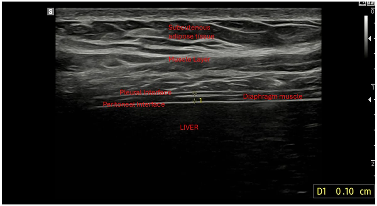 Figure 3. B-mode ultrasound image of the right hemidiaphragm obtained with a high-frequency linear transducer, showing diaphragm thickness measurement at a defined respiratory phase for diap