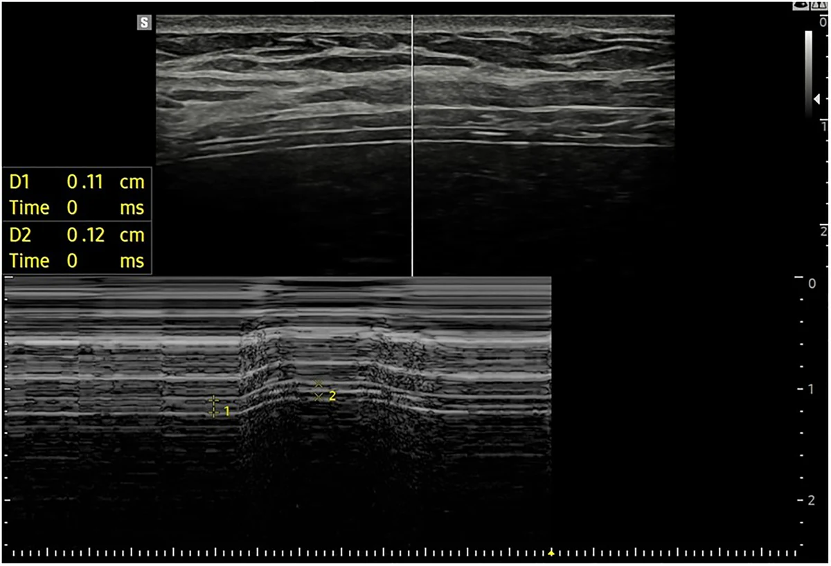 Figure 4. Combined B-mode and M-mode ultrasound of the right hemidiaphragm using a high-frequency linear transducer, demonstrating diaphragm thickness measurements at end-expiration and end-