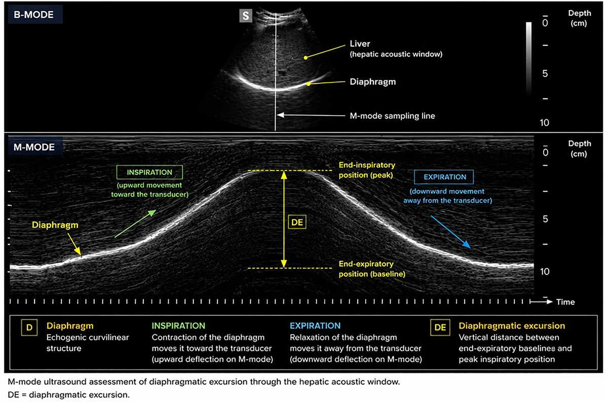 Figure 6. M-mode ultrasound tracing of the diaphragm demonstrating reduced diaphragmatic excursion. The cursor is aligned over the diaphragmatic dome, and the motion-time waveform shows a re
