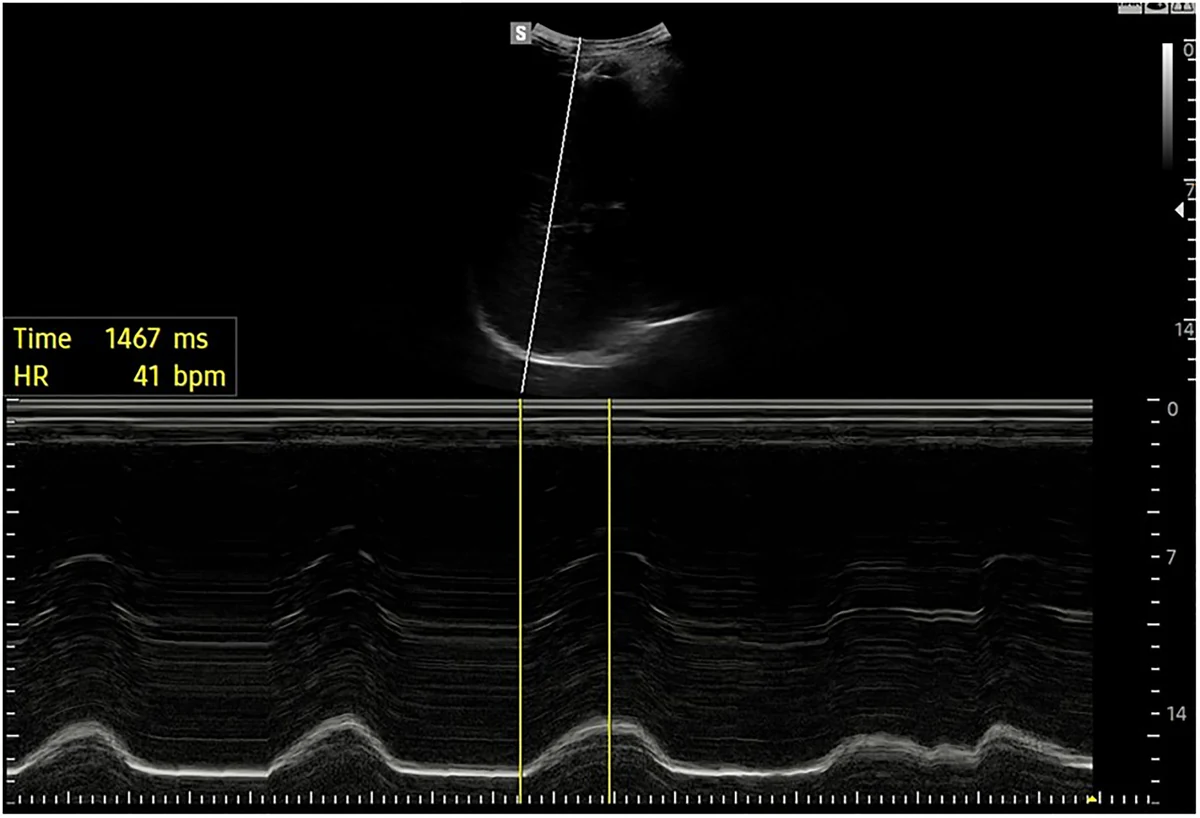 Figure 7. M-mode ultrasound assessment of diaphragmatic excursion. The cursor is aligned perpendicular to the diaphragm dome, and the resulting tracing shows respiratory-related movement ove